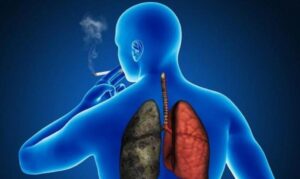 Hablando del cáncer de pulmón 