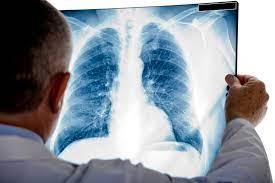 Hablando del cáncer de pulmón 