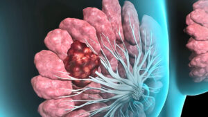 cáncer de mama metastásico