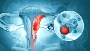 cáncer de cuello de útero