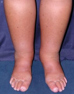 linfedema