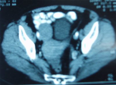 cáncer de ovario