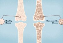 Dieta sana, evitar hábitos nocivos y hacer ejercicio físico, claves para mejorar la osteoporosis Osteoporosis